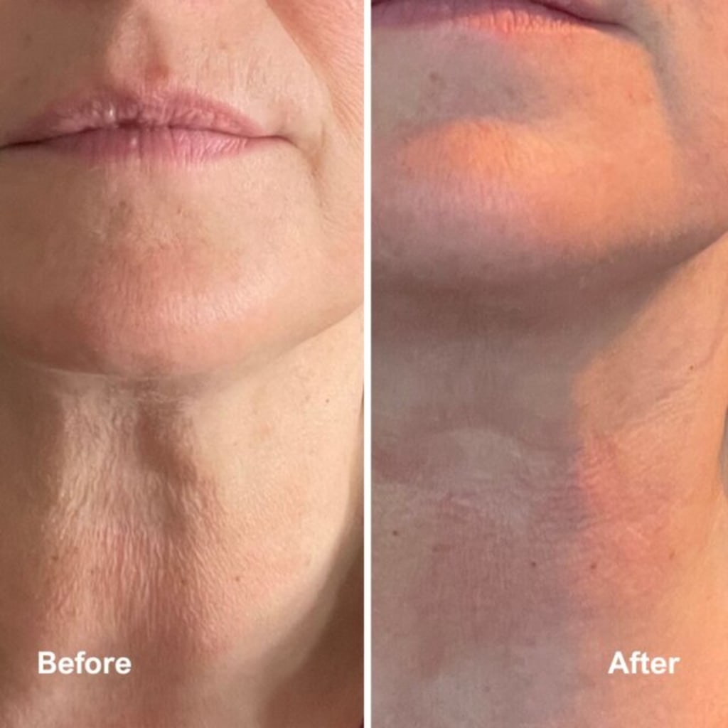 Bloomskin RegenMask LED & Microcurrent Mask for Lifting Jowls, Cheeks, and Lower Face