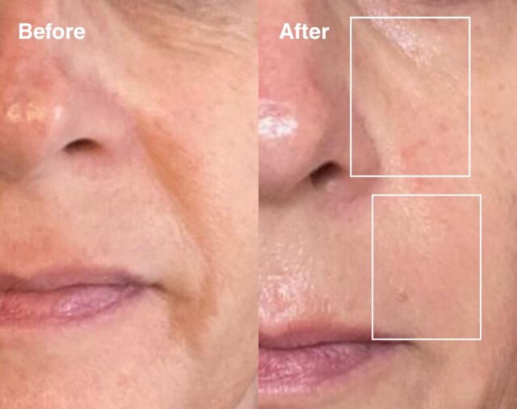 Bloomskin RegenMask LED & Microcurrent Mask for Lifting Jowls, Cheeks, and Lower Face