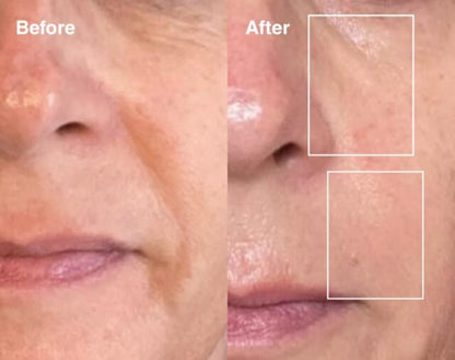 Bloomskin RegenMask LED & Microcurrent Mask for Lifting Jowls, Cheeks, and Lower Face